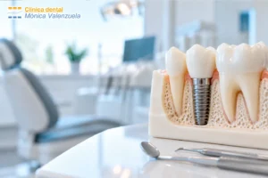Implante dental de titanio y corona dental – Clínica Dental Mónica Valenzuela en León.